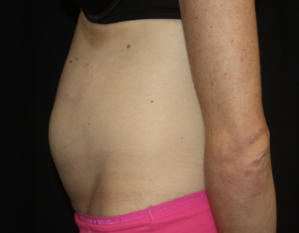 Tummy Tuck Before & After Patient #28691