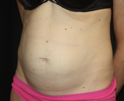 Tummy Tuck Before & After Patient #28691