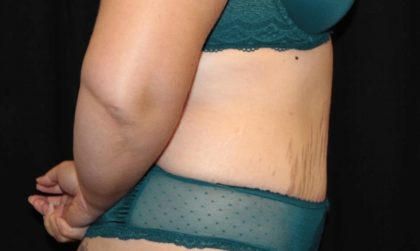 Tummy Tuck Before & After Patient #28742