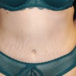 Tummy Tuck Before & After Patient #28742