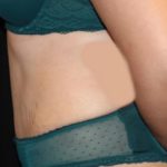 Tummy Tuck Before & After Patient #28742