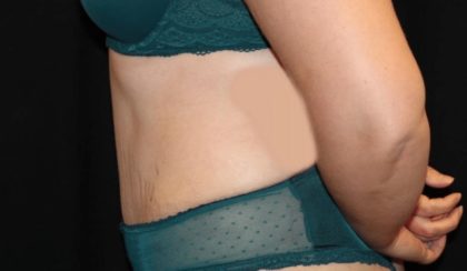 Tummy Tuck Before & After Patient #28742