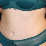 Tummy Tuck Before & After Patient #28742