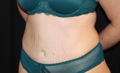 Tummy Tuck Before & After Patient #28742