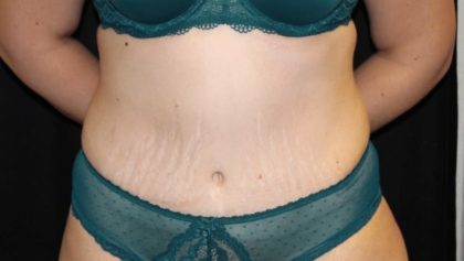 Tummy Tuck Before & After Patient #28742