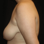 Breast Lift Before & After Patient #28600