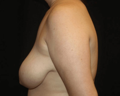 Breast Lift Before & After Patient #28600
