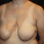 Breast Lift Before & After Patient #28600