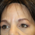 Brow Lift Before & After Patient #28713