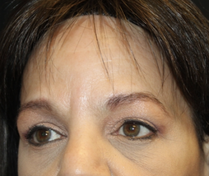 Brow Lift Before & After Patient #28713