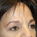 Brow Lift Before & After Patient #28713