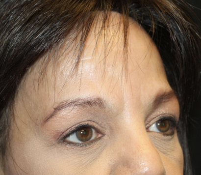 Brow Lift Before & After Patient #28713