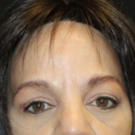 Brow Lift Before & After Patient #28713