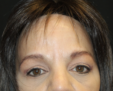 Brow Lift Before & After Patient #28713