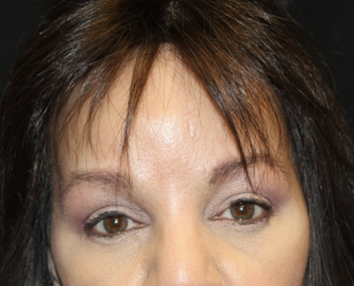 Brow Lift Before & After Patient #28713
