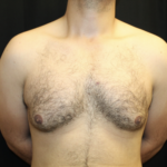 Gynecomastia Before & After Patient #28649