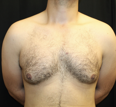 Gynecomastia Before & After Patient #28649