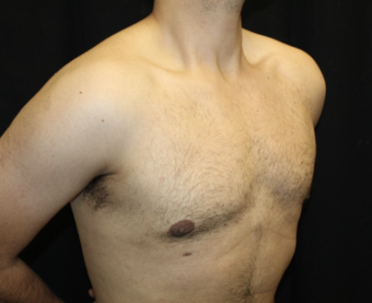 Gynecomastia Before & After Patient #28649