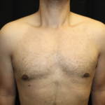 Gynecomastia Before & After Patient #28649