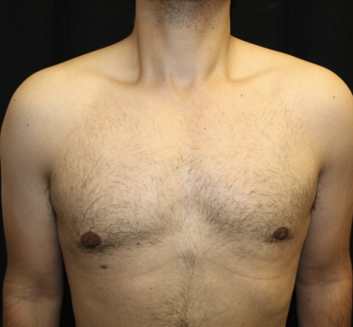 Gynecomastia Before & After Patient #28649