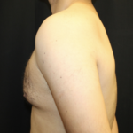 Gynecomastia Before & After Patient #28649