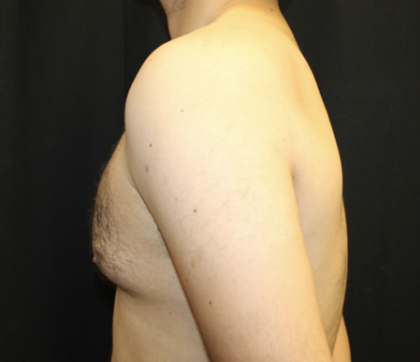 Gynecomastia Before & After Patient #28649