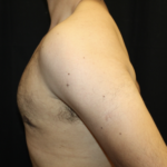 Gynecomastia Before & After Patient #28649