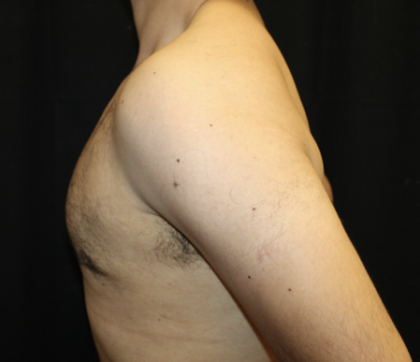 Gynecomastia Before & After Patient #28649