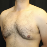 Gynecomastia Before & After Patient #28649