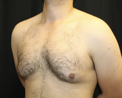 Gynecomastia Before & After Patient #28649