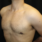 Gynecomastia Before & After Patient #28649