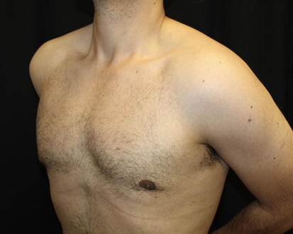 Gynecomastia Before & After Patient #28649