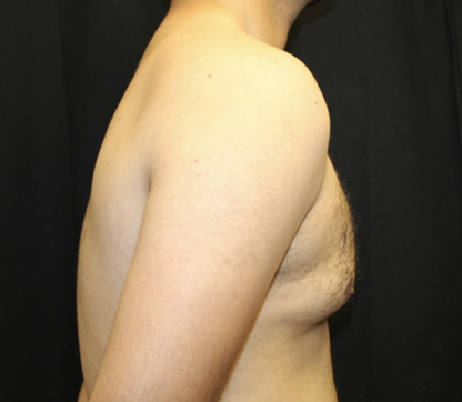 Gynecomastia Before & After Patient #28649