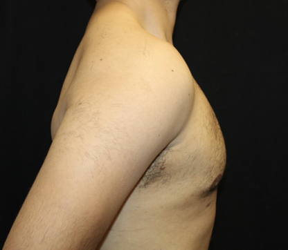 Gynecomastia Before & After Patient #28649