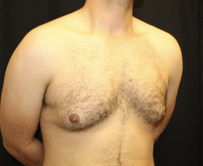 Gynecomastia Before & After Patient #28649