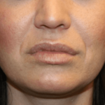Injectable Fillers Before & After Patient #28607