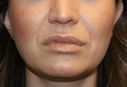 Injectable Fillers Before & After Patient #28607