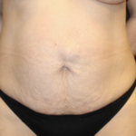 Tummy Tuck Before & After Patient #28671