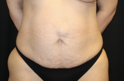 Tummy Tuck Before & After Patient #28671