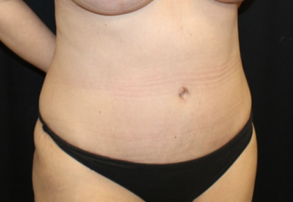 Tummy Tuck Before & After Patient #28671