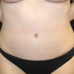 Tummy Tuck Before & After Patient #28671
