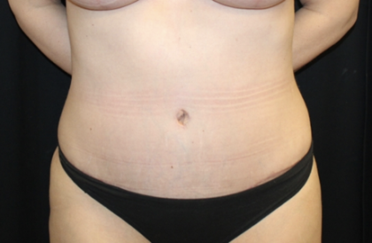 Tummy Tuck Before & After Patient #28671