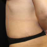 Tummy Tuck Before & After Patient #28671