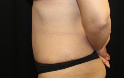 Tummy Tuck Before & After Patient #28671