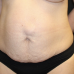 Tummy Tuck Before & After Patient #28671