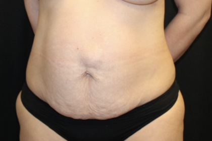 Tummy Tuck Before & After Patient #28671