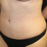 Tummy Tuck Before & After Patient #28671