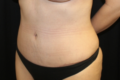 Tummy Tuck Before & After Patient #28671