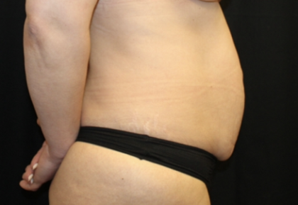 Tummy Tuck Before & After Patient #28671