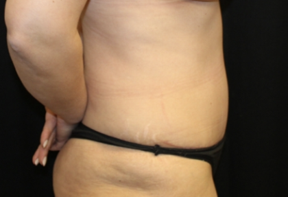 Tummy Tuck Before & After Patient #28671